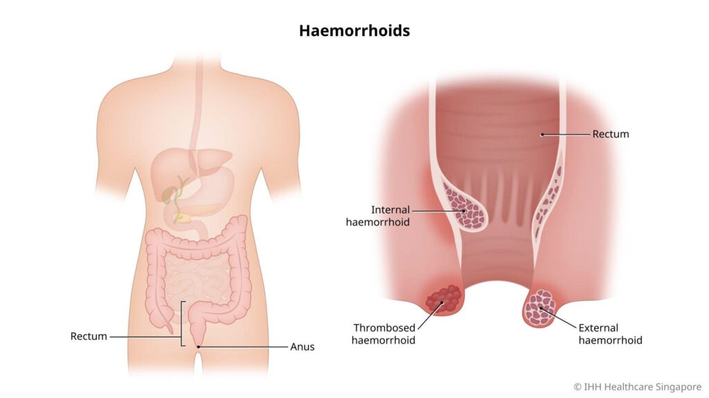 Can Stress Cause Hemorrhoids?