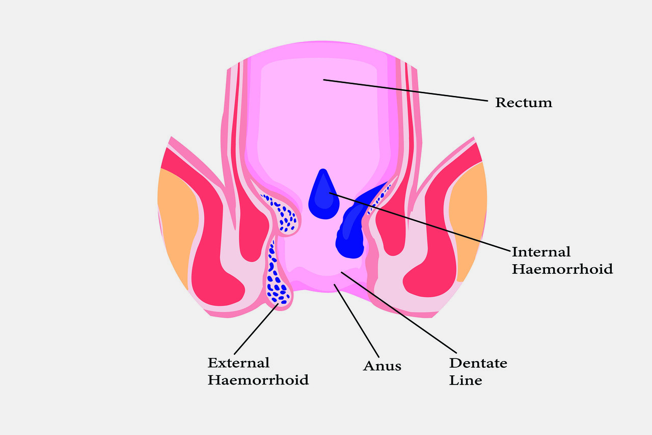 Can Stress Cause Hemorrhoids?
