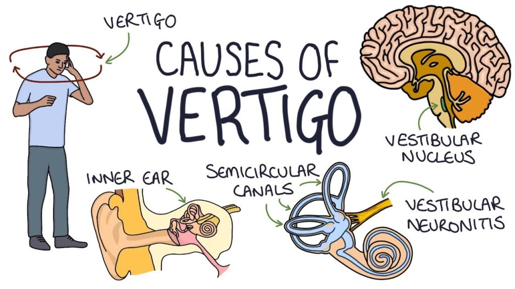Does Stress Cause Vertigo?