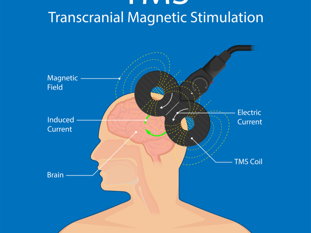 TMS Therapy Near Me