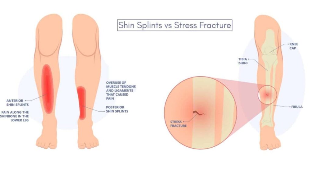 What Does a Stress Fracture Feel Like?
